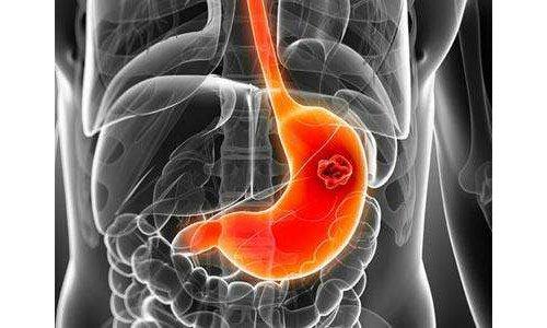胃癌综述，胃癌病因是什么？临床表现有哪些？如何检查、治疗、护理及预防？