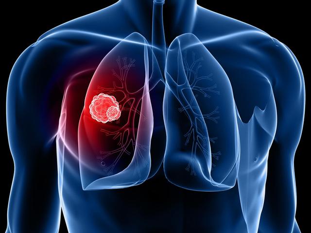 预防肺癌有6个方法，能做到一个都很好