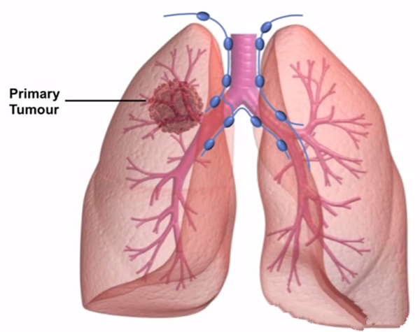 小细胞肺癌患者出现纵隔淋巴结转移该如何治疗