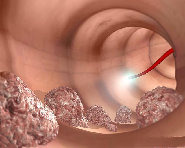 肿瘤癌症两者之间的区别你可要搞清楚了