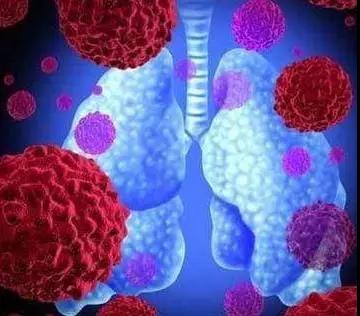 肺癌晚期扩散转移还能活多久？