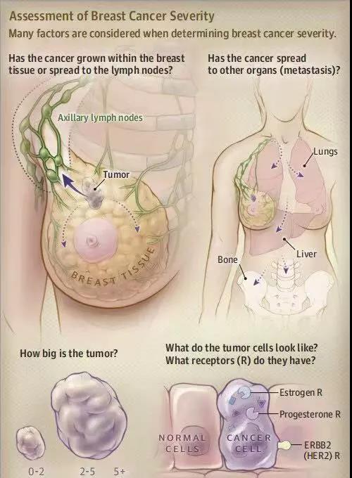 全乳放療是乳腺癌保乳手術的必要組成部分.