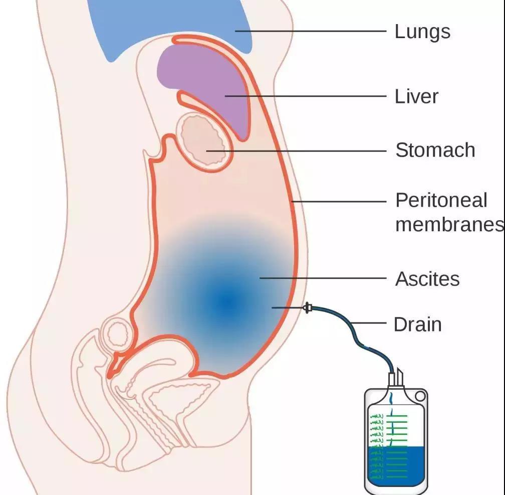 肿瘤患者出现恶性腹水怎么办