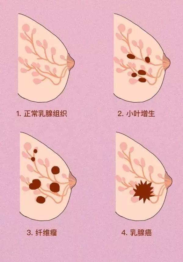 乳腺结节外观图片